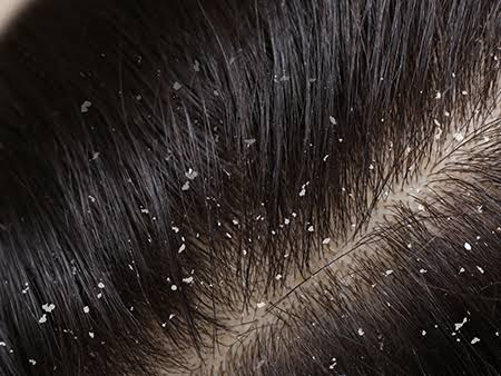 Dandruff, Seborrheic Dermatitis, Psoriasis And Its Difference