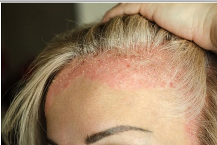 Benefits Of Clove Water And Fenugreek For Eczema