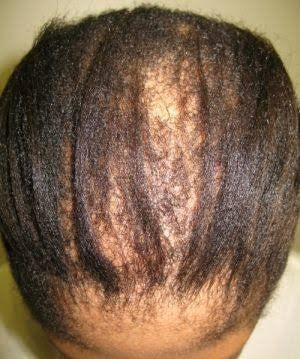 TRACTION ALOPECIA IN AFRO HAIR